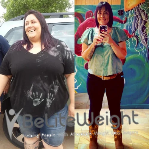 Weight Loss Surgery Gastric Sleeve before and after